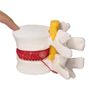 Human Herniated Disc Model, Anatomical Herniated Lumbar Vertebrae Disc Prolapse Model for Medical Teaching Learning, Kids Learning Education Display Toolning, Kids Learning Education Display Tool