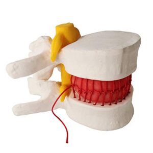 Human Herniated Disc Model, Anatomical Herniated Lumbar Vertebrae Disc Prolapse Model for Medical Teaching Learning, Kids Learning Education Display Toolning, Kids Learning Education Display Tool