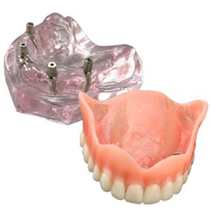 dental model overdenture upper teeth 4 implants demo for teaching and studying