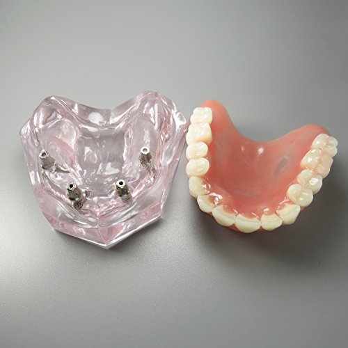 Dental Model Overdenture Upper Teeth 4 Implants Demo for Teaching and Studying