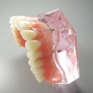 Dental Model Overdenture Upper Teeth 4 Implants Demo for Teaching and Studying