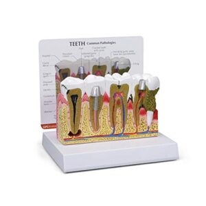 dental model | human body anatomy replica of teeth w/common pathologies for dentist office educational tool | gpi anatomicals