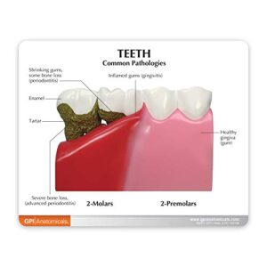 Dental Model | Human Body Anatomy Replica of Teeth w/Common Pathologies for Dentist Office Educational Tool | GPI Anatomicals