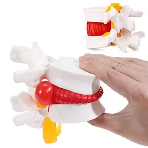 asintod human anatomy lumbar disc herniation model,a model showing the anatomy of human lumbar disc, an excellent choice for teaching and learning the human lumbar spine