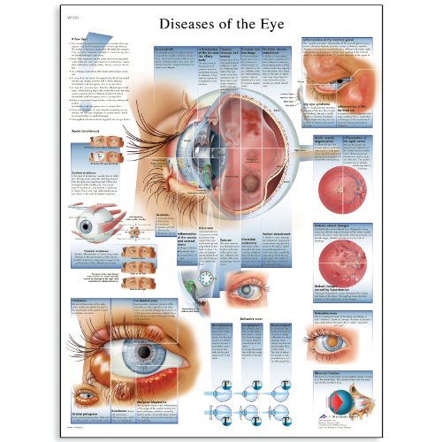 3B Scientific VR1231UU Glossy Paper Diseases of The Eye Anatomical Chart, Poster Size 20" Width x 26" Height