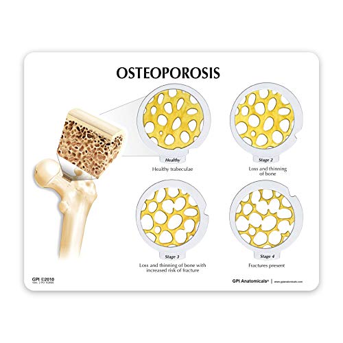 Osteoporosis Model | Human Body Anatomy Four Piece Hinged Disk Set of Progressive Bone Thinning for Doctors Office Educational Tool | GPI Anatomicals