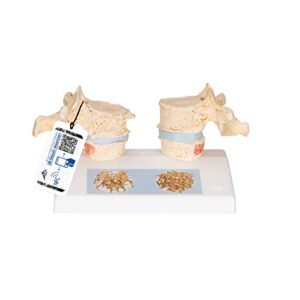 3b scientific a95 osteoporosis model – 3b smart anatomy