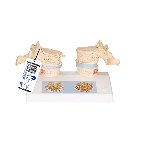 3B Scientific A95 Osteoporosis Model - 3B Smart Anatomy