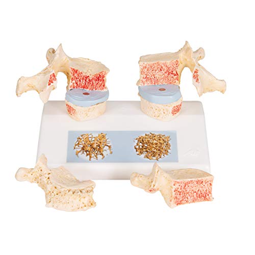 3B Scientific A95 Osteoporosis Model - 3B Smart Anatomy