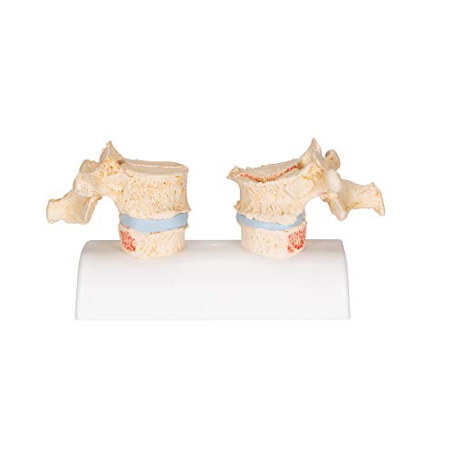 3B Scientific A95 Osteoporosis Model - 3B Smart Anatomy