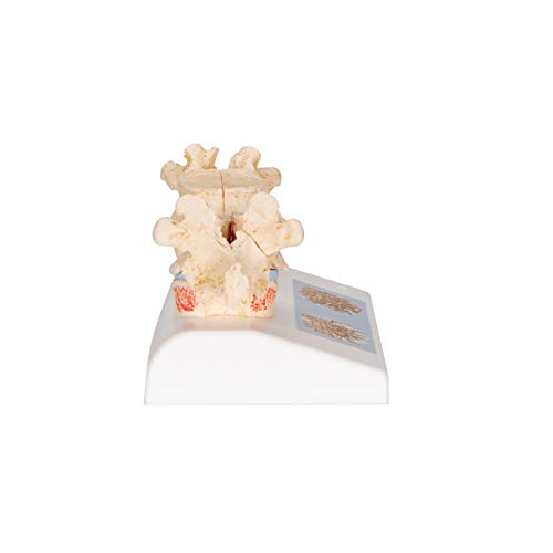 3B Scientific A95 Osteoporosis Model - 3B Smart Anatomy