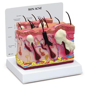 skin acne cross-section model | human body anatomy replica of common skin acne for dermatology educational tool | gpi anatomicals