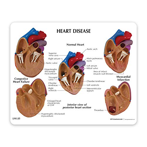 Heart Model Set | Human Body Anatomy Replica Heart Disease Set for Doctors Office Educational Tool | GPI Anatomicals