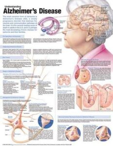 understanding alzheimer’s disease anatomical chart