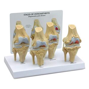 gpi anatomicals knee joint model set | human body anatomy replica set of 4-stage osteoarthritis knee joint for doctors office educational tool