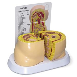 obesity model | human body anatomy replica of overweight body types for doctors office educational tool | gpi anatomicals