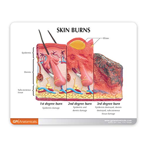 Skin Burn Model | Human Body Anatomy Replica of Varying Degrees of Skin Burn for Dermatology Educational Tool | GPI Anatomicals