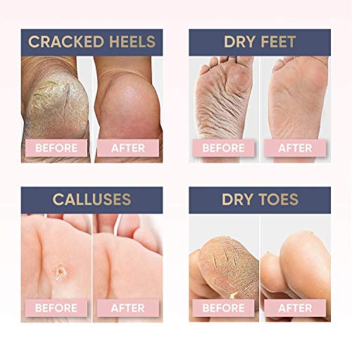 Peel Mask for Dry Hard Feet - Dead Skin & Callus Remover - Foot Spa Experience at Home for Baby Soft Feet - Large Size Exfoliating Socks for Woman and Man - Foot Care Treatment for Healthy Feet 8 Pack