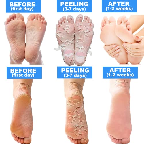 5 Pack Foot Peel Mask, Exfoliator Peel Off Calluses Dead Skin Callus Remover,Foot Mask for Dry Cracked Feet Soft Exfoliating Foot Mask Peel with Lavender and Rose Gel for Men and Women Feet Peeling Mask