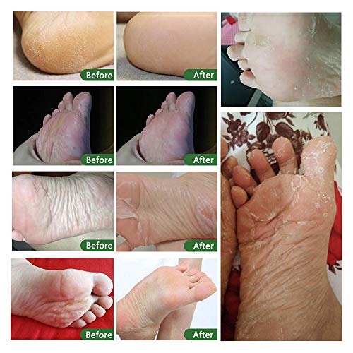 Foot Peel Mask - 5 Pack of Tea Tree Foot Mask - Removes Calluses,Dead and Dry Skin - Repairs Rough Heels, Foot Peeling Mask for Women and Men