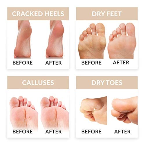 I PEEL GOOD! This 4-pair foot mask provides an at-home pampering spa experience to intensely moisturize, repair and soften rough and dry feet. The foot mask penetrates deeply to heal and hydrate dry cracked skin, restoring your skin's natural moisture bal