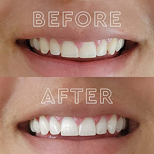 MOON Teeth Whitening Kit with LED Light, Wireless, 5 Minute Treatment, Gentle on Teeth, Helps Remove Stains from Coffee, Smoking, Wine, Soda