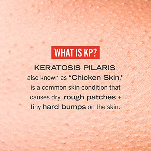 First Aid Beauty KP Bump Eraser Body Scrub Exfoliant for Keratosis Pilaris with 10% AHA – 8 oz