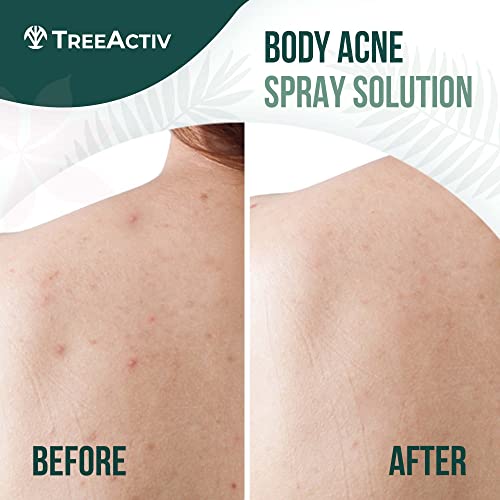 TreeActiv Salicylic Acid Back & Body Acne Spray - 2% Salicylic Acid Spray for Back Acne Solution For Women And Men - Back Acne Treatment Organic For Body That Prevents & Shrinks Body Acne - 4oz 2-pack