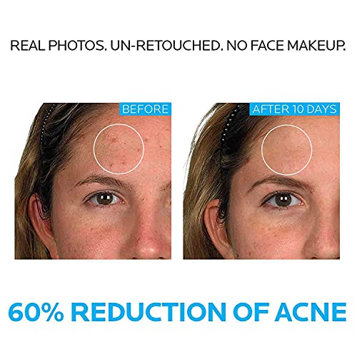 La Roche-Posay Effaclar Dermatological 3 Step Acne Treatment System, Salicylic Acid Acne Cleanser, Pore Refining Toner, and Benzoyl Peroxide Acne Spot Treatment for Sensitive Skin, 2-Month Supply