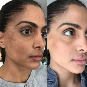 Stop Guessing Cleanser for Melasma Treatment - Fast Dark Spot Remover/Age Spot Remover