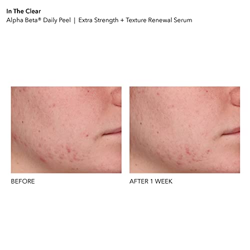 Dr. Dennis Gross In The Clear Retinol + AHA/BHA SetL Alpha Beta Extra Strength Daily Peel (14 Packettes) + Advanced Retinol + Ferulic Texture Renewal Serum (full size 1 oz)