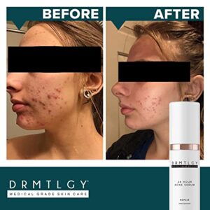 DRMTLGY Acne Spot Treatment and Cystic Acne Treatment. Acne Serum with Micronized Benzoyl Peroxide 5% and Glycolic Acid