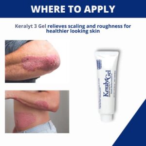 Keralyt 3% Salicylic Acid Gel - Exfoliating Moisturizing Skin Gel - Promotes Relief from Itchy, Redness, Dryness, Roughness, and Flakey Skin from Psoriasis, Eczema, Acne, Dermatitis