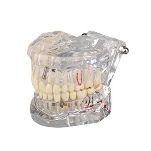 ultrassist transparent disease teeth model with dental implant bridge, dental model for patient and dental student education