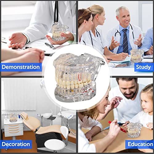 Ultrassist Transparent Disease Teeth Model with Dental Implant Bridge, Dental Model for Patient and Dental Student Education