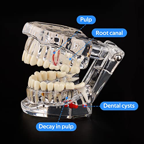 Ultrassist Transparent Disease Teeth Model with Dental Implant Bridge, Dental Model for Patient and Dental Student Education