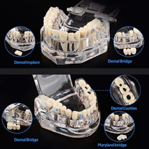 Ultrassist Transparent Disease Teeth Model with Dental Implant Bridge, Dental Model for Patient and Dental Student Education