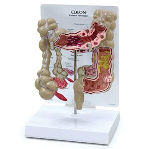 colon model | human body anatomy replica of colon w/common pathologies for doctors office educational tool | gpi anatomicals