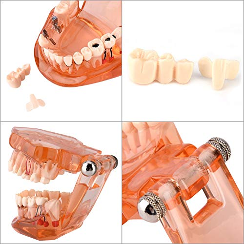 Maxmartt Teeth Model, Dental Demonstration Dental Implant Removable Study Model Teeth Teaching Model for Student Teacher, Orange