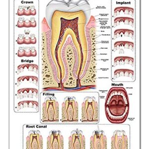 Tooth Repair Poster, Chart (PVC, Large 24x36)