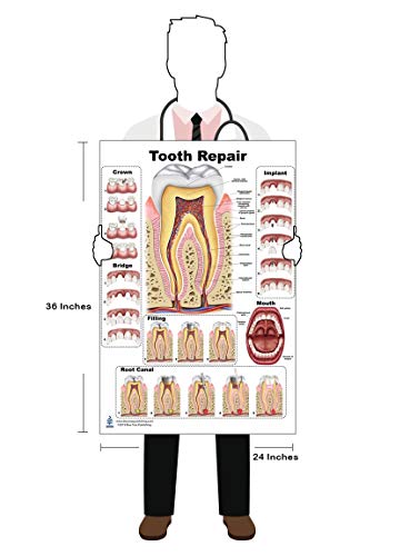 Tooth Repair Poster, Chart (PVC, Large 24x36)