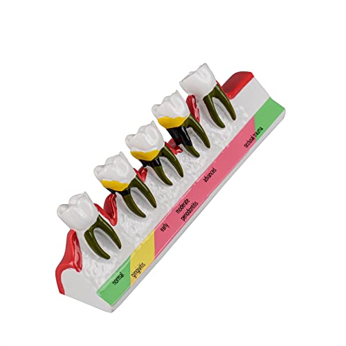 Ultrassist Dental Periodontal Disease Model, Dental Teeth Model for Dental Tooth Anatomy Study, Doctor-Patient and Oral Care Education