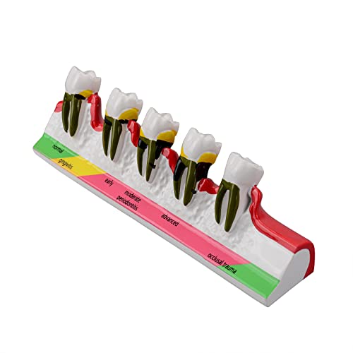 Ultrassist Dental Periodontal Disease Model, Dental Teeth Model for Dental Tooth Anatomy Study, Doctor-Patient and Oral Care Education