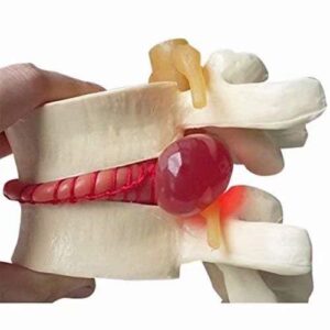 Human Lumbar Disc Herniation Demonstration Model Human Spine Anatomical Model Yellow