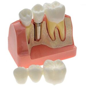 1 pcs dental model implant analysis crown bridge demonstration teeth model for education