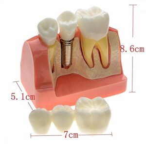 1 PCS Dental Model Implant Analysis Crown Bridge Demonstration Teeth Model for Education