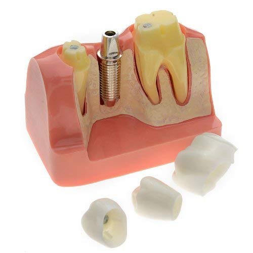 1 PCS Dental Model Implant Analysis Crown Bridge Demonstration Teeth Model for Education