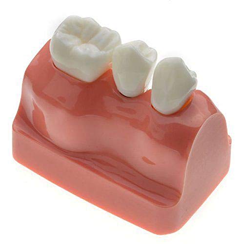 1 PCS Dental Model Implant Analysis Crown Bridge Demonstration Teeth Model for Education