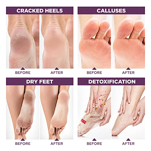 Foot Exfoliator Peeling Mask for Dry Cracked Feet - 3 Pack - Remove Dead Skin and Toxins with Lavender Foot Detox Effect - Foot Peel Mask for Baby Soft Feet by Lavinso