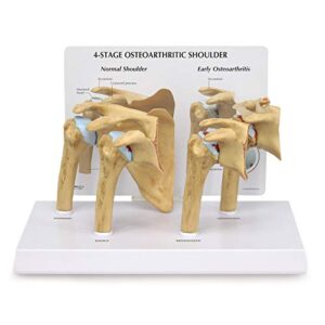 gpi anatomicals shoulder joint model set | human body anatomy replica set of 4-stage osteoarthritis shoulder joint for doctors office educational tool